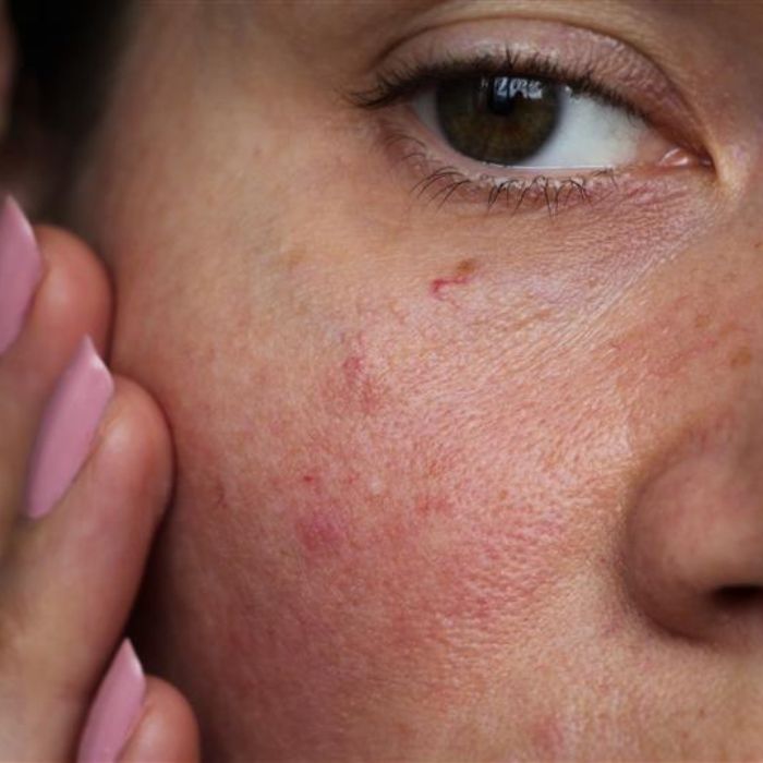 Piel reactiva: ¿todo lo que necesitas saber y cómo reaccionar?