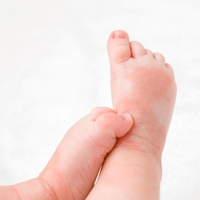 Piel atópica: cómo cuidarla y vivir mejor con ella