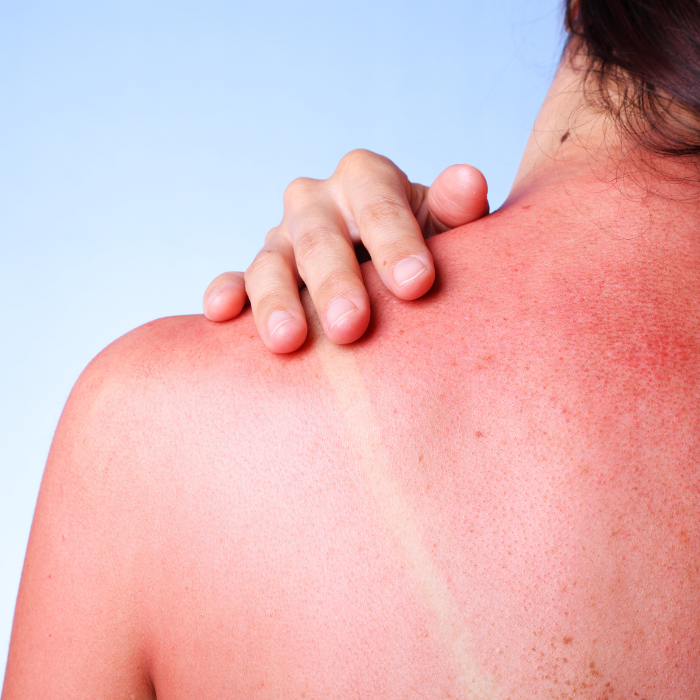DOS-AVEC-COUP-DE-SOLEIL