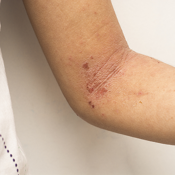PSORIASIS-SUR-UN-AVANT-BRAS