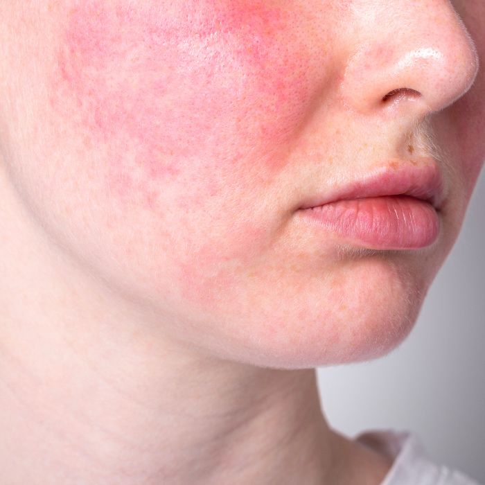 FEMME-AVEC-ROUGEURS-SUR-UNE-JOUE-SIGNE-DE-PEAU-REACTIVE
