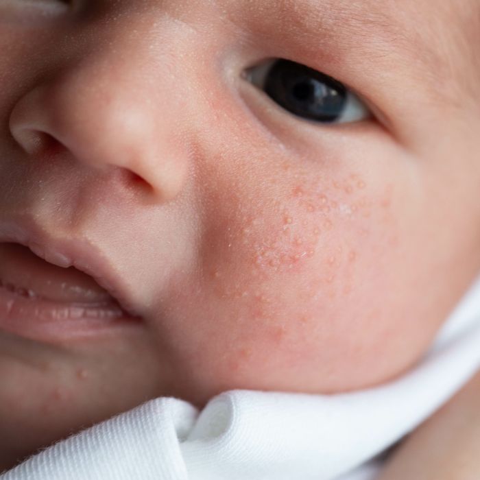 CANE-SUR-JOUE-DE-BEBE