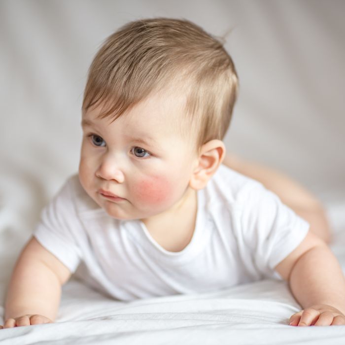 BEBE-AVEC-DES-JOUES-ROUGES-ET-IRRITEES