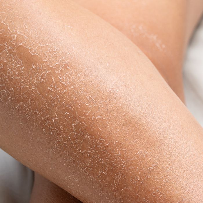 JAMBE-A-LA-PEAU-SQUAMEUSE