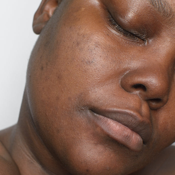 FEMME-PEAU-NOIRE-AVEC-TACHES-PIGMENTAIRES