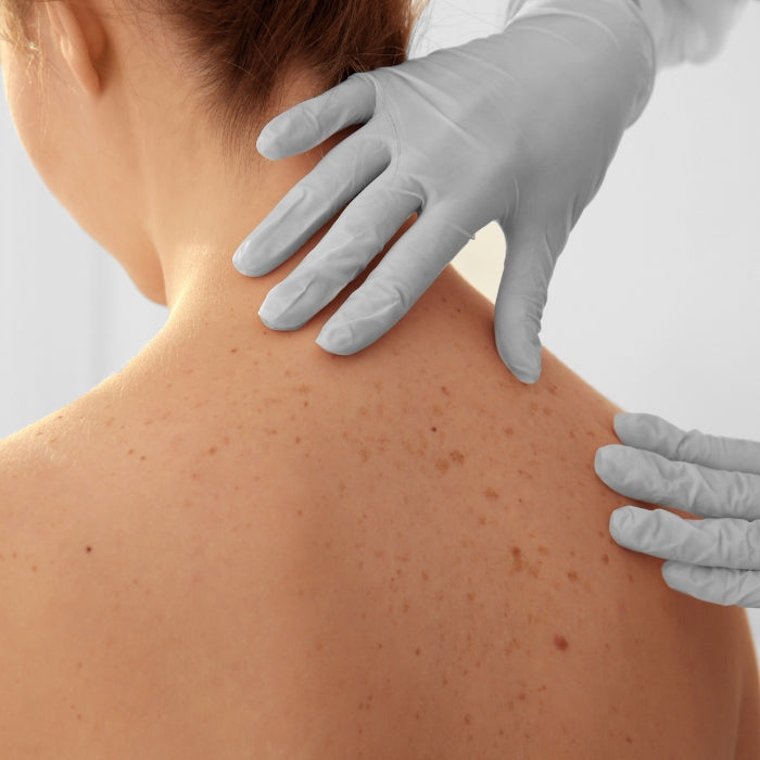 UN-DERMATOLOGUE-ANALYSELE-DOS-DUNE-PATIENTE-AYANT-DES-GRAINS-DE-BEAUTE
