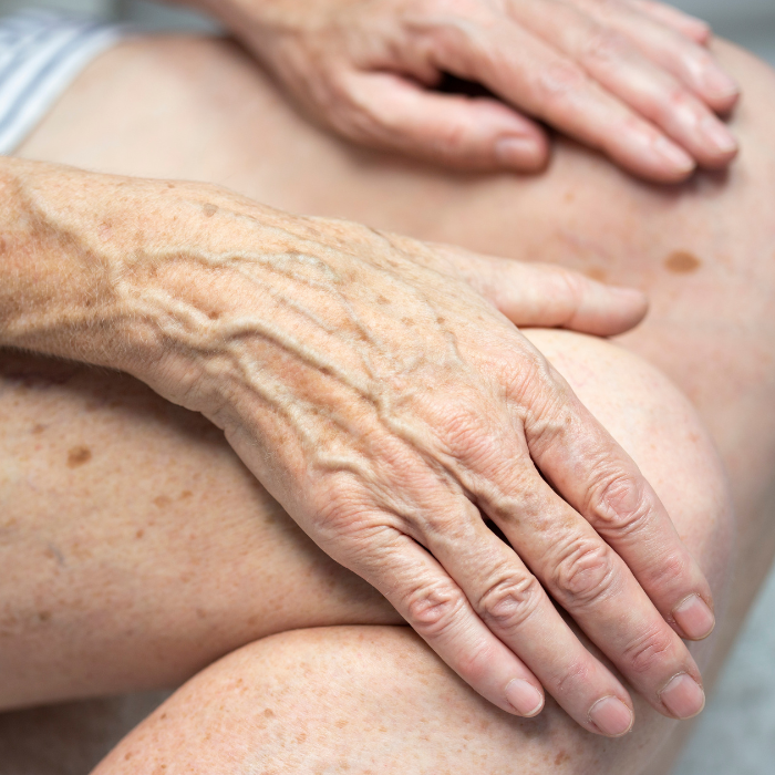 JAMBE-ET-MAIN-PERSONNE-AGEE-AVEC-TACHES-PIGMENTAIRES